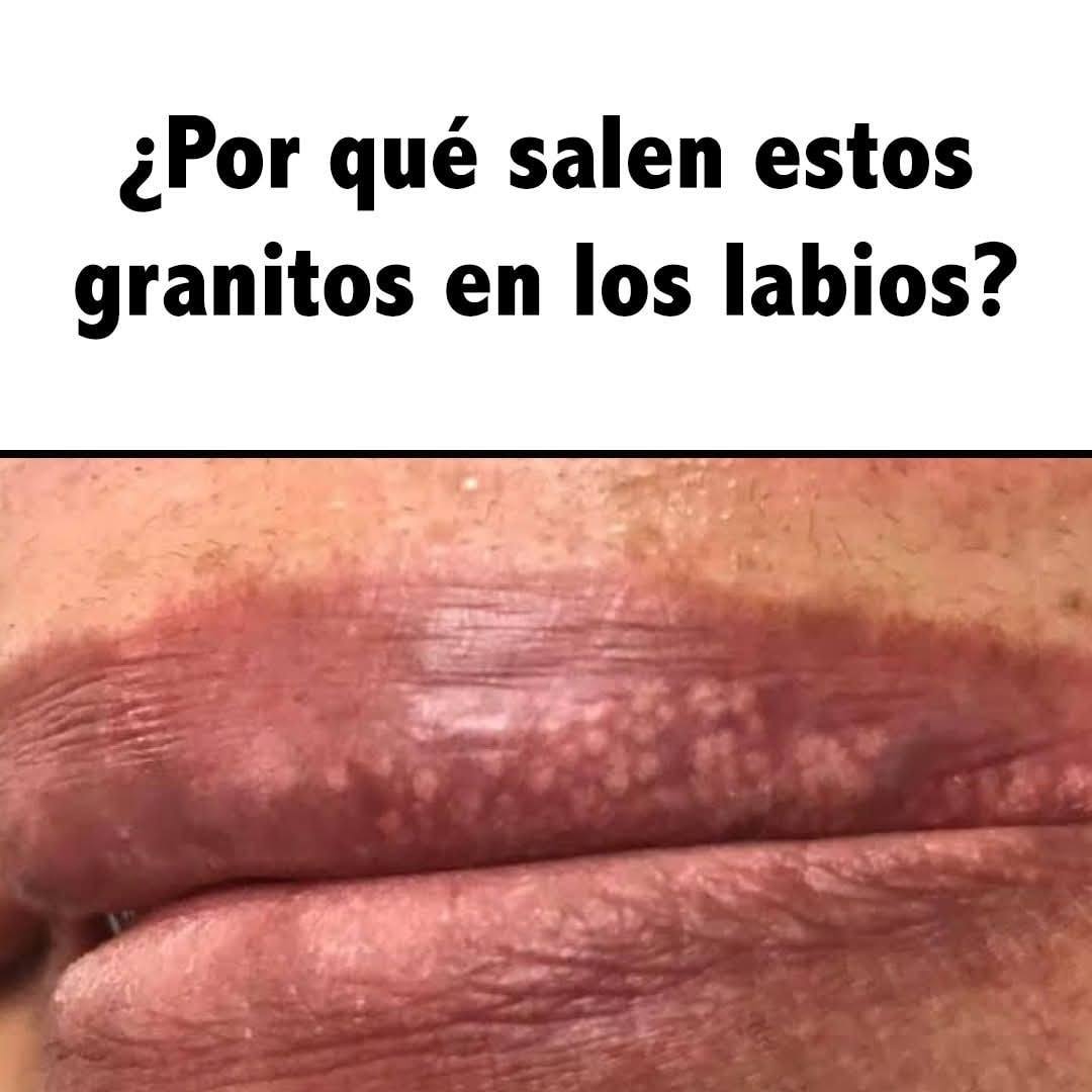 ¿Por Qué Salen Estos Granitos en los Labios? Causas Más Comunes que Debes Conocer