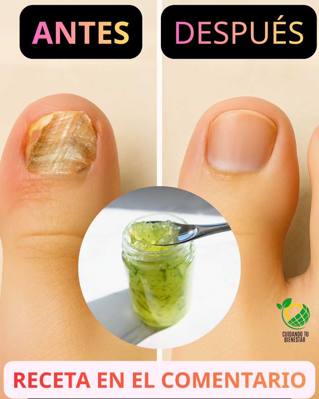 ¡Adiós a los Hongos! El Remedio Casero Antimicótico que Transformará tus Pies y Uñas