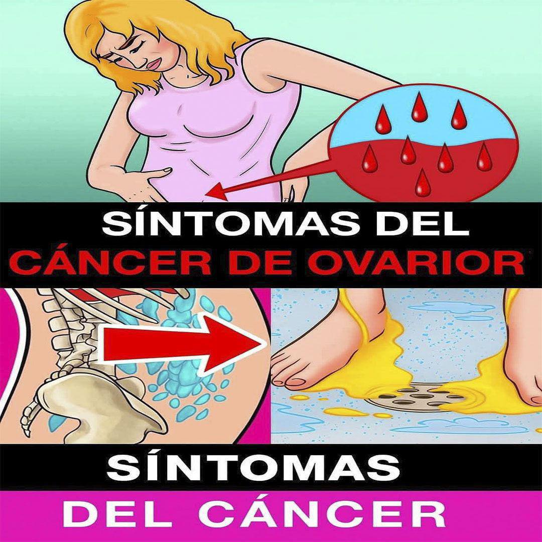 Cáncer de Ovarios: Lo Que Toda Mujer Debería Saber