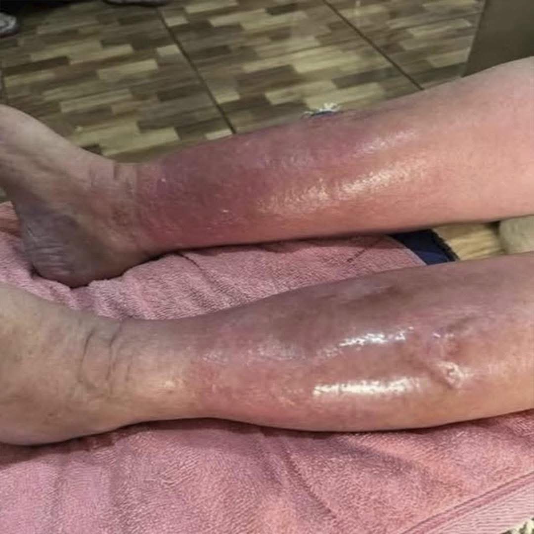 Señales De Que Podrías Tener Psoriasis: Cómo Identificarla, Cuándo Ver Al Médico Y Opciones De Tratamiento