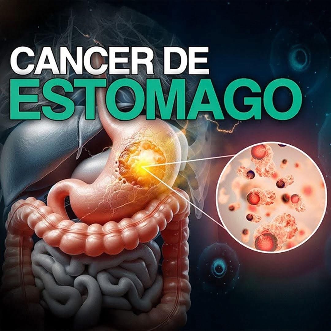 Los Silenciosos Síntomas del Cáncer de Estómago
