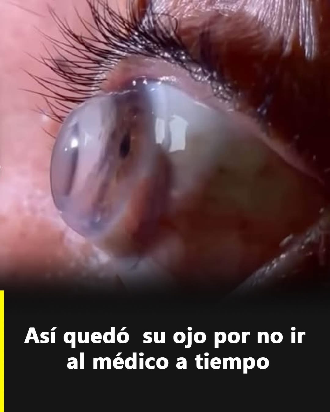 Qué es el queratocono y cómo evoluciona hasta sus formas más avanzadas