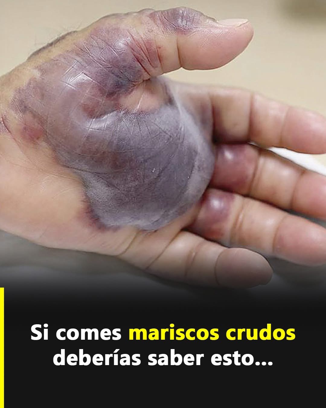 Vibrio vulnificus: la bacteria marina que preocupa a los especialistas