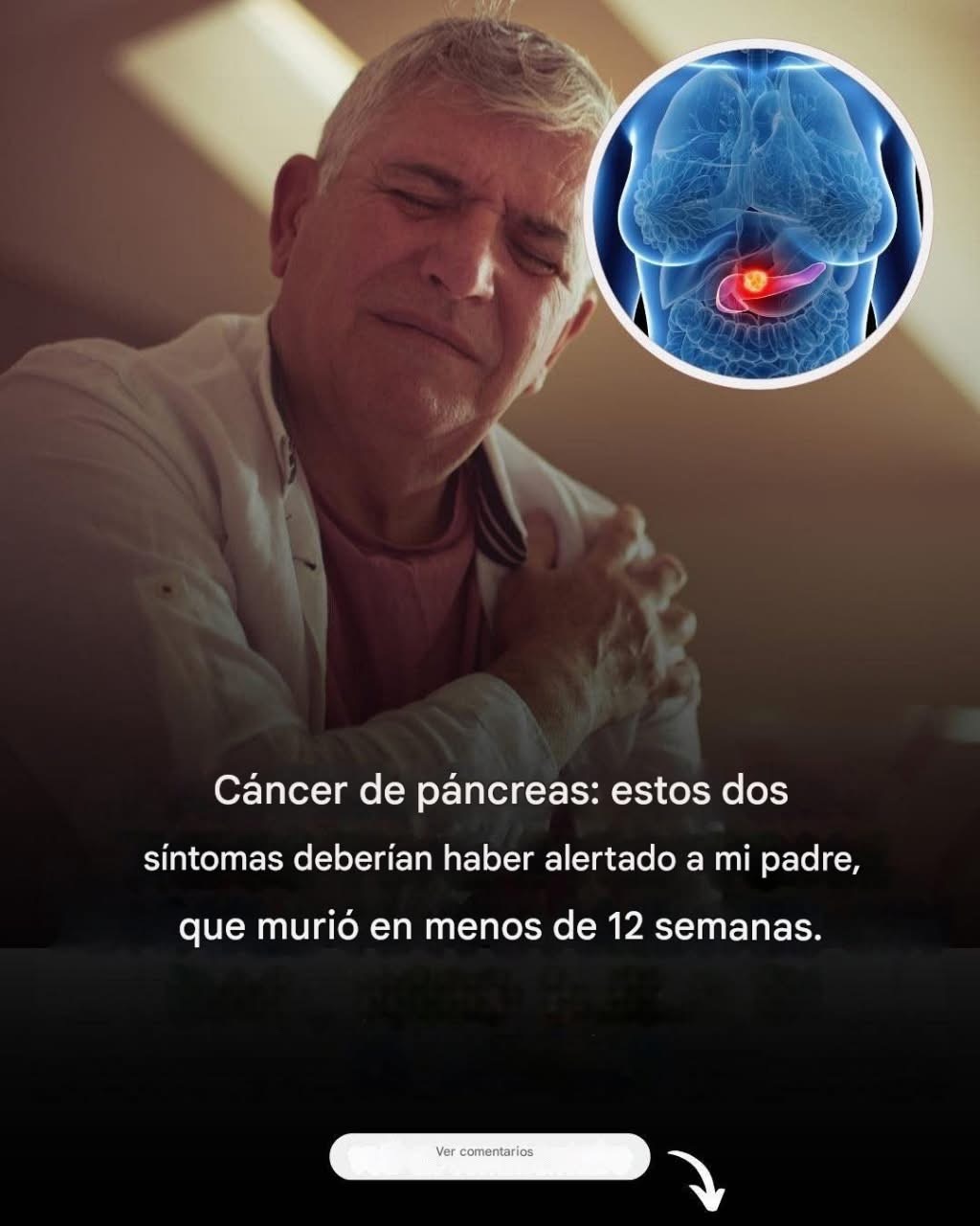 Cáncer de páncreas: dos señales tempranas de un cáncer a menudo mortal