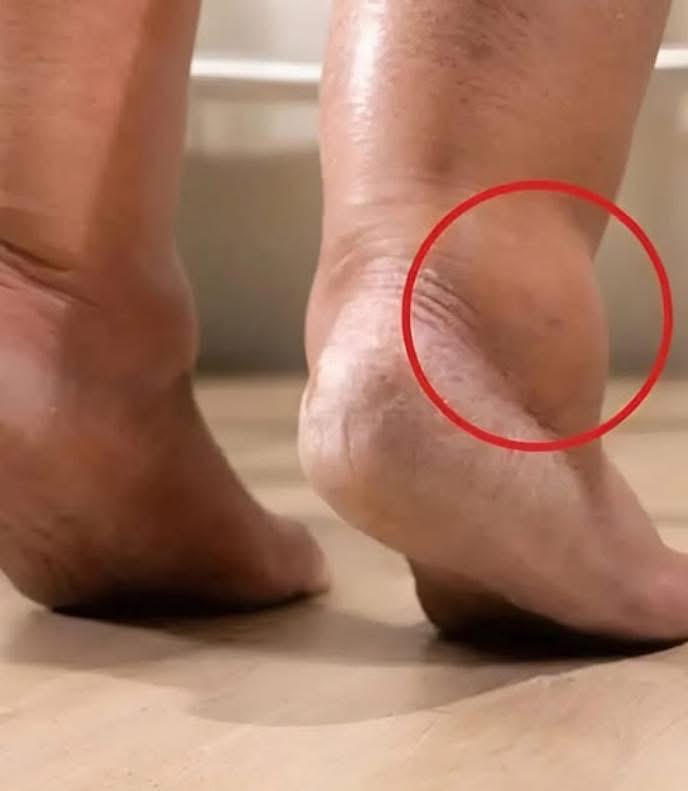 ¿Lo sabías? Los pies hinchados pueden revelar más de lo que imaginas