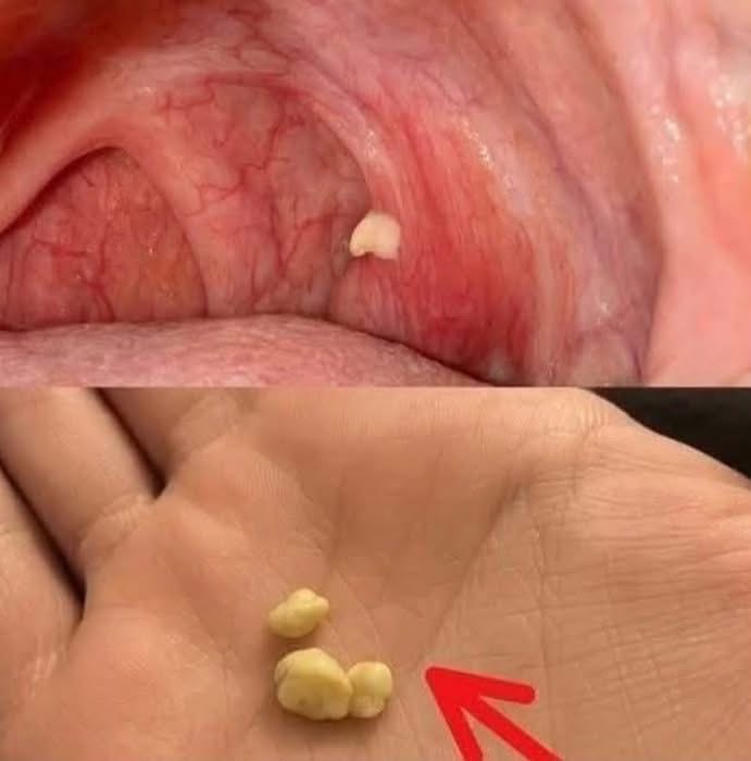 Sabías que si te salen estas bolitas blancas en la boca podría ser SEÑAL de algo importante?