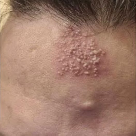 Cómo Eliminar Hongos de la Piel de Forma Efectiva