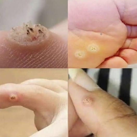 Verrugas plantares: lo que debes saber para reconocerlas, tratarlas y prevenirlas