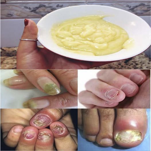 El peligro oculto detrás de las infecciones en las uñas y cómo un simple remedio natural puede ayudarte a combatirlas