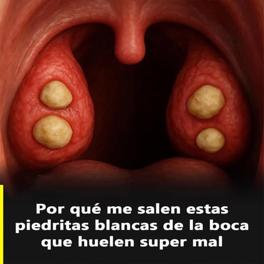 Que son los tonsilolitos y como eliminarlos