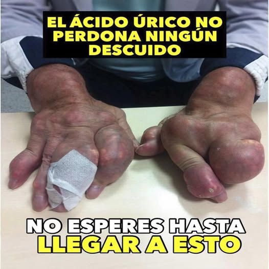 Ácido úrico: Síntomas y Tratamientos Naturales