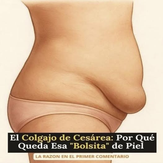 ¿Por qué queda esa bolsita de piel colgando después de una cesárea?