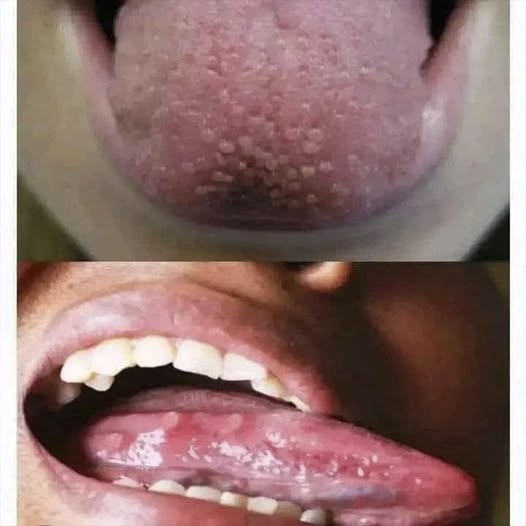 ¿Por qué tengo la lengua blanca? Lo que tu cuerpo quiere decirte