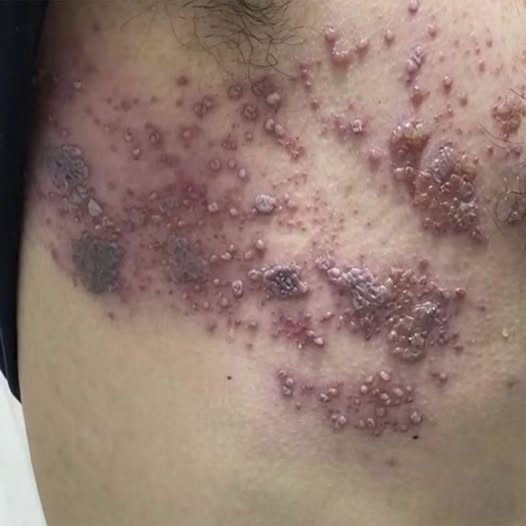 Cómo Eliminar Hongos de la Piel de Forma Efectiva