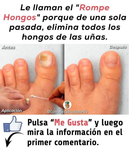 Remedio casero para los hongos en los pies (pie de atleta)