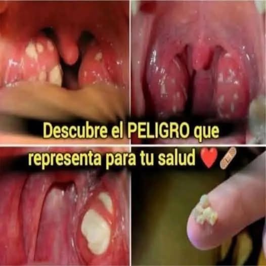 Bolitas blancas en la garganta = MAL ALIENTO