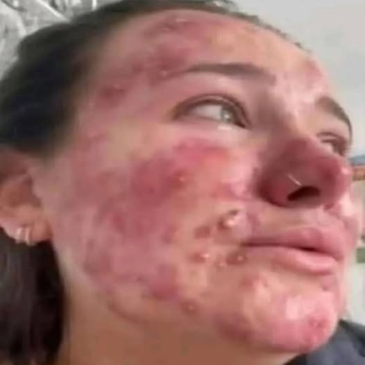 Cuando la piel grita: la dura realidad de los brotes severos en el rostro