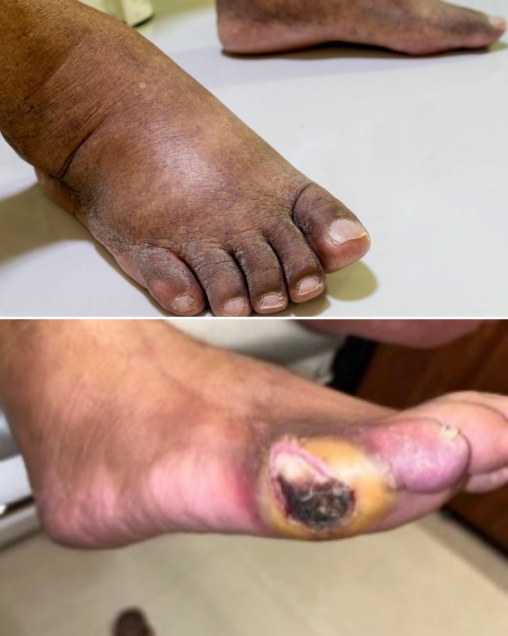 ⚠️ Hinchazón y heridas graves en los pies: señales de alerta que NO debes ignorar