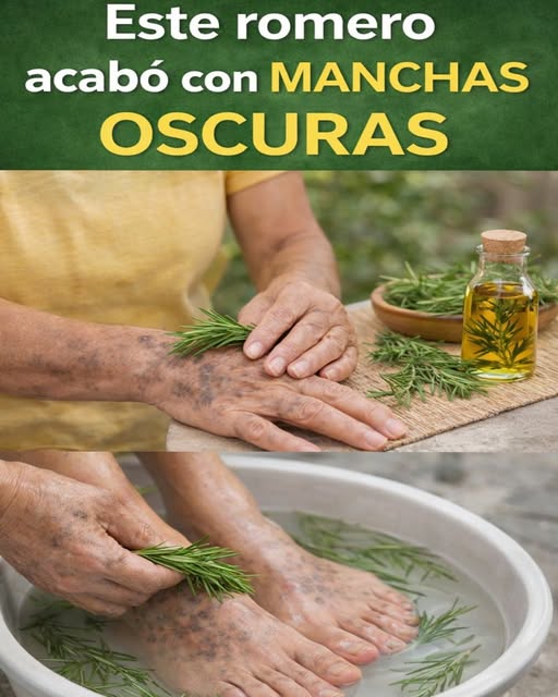 Romero para várices: el ritual realista que puede apoyar tus piernas