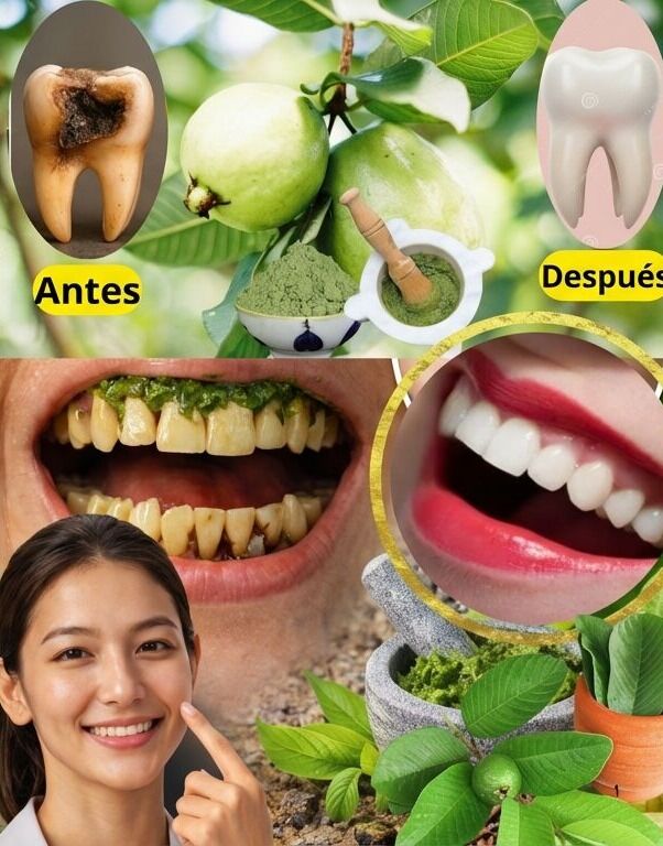 Descubre el secreto de la naturaleza: 3 poderosos remedios con hojas de guayaba para combatir la caries dental